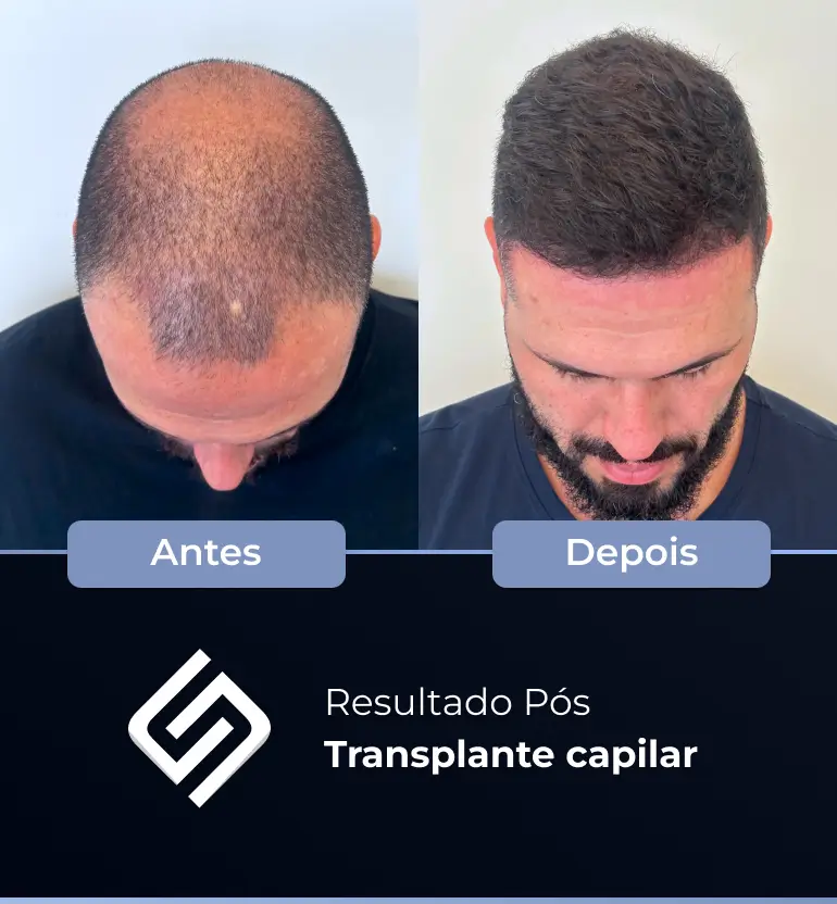 SN - antes e depois tc 01