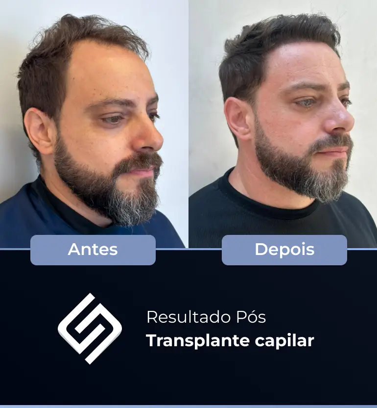 SN - antes e depois tc 12