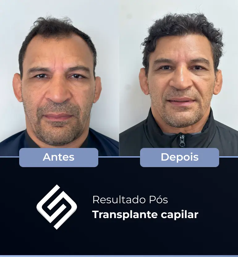 SN - antes e depois tc 14