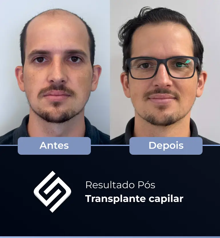 SN - antes e depois tc 19