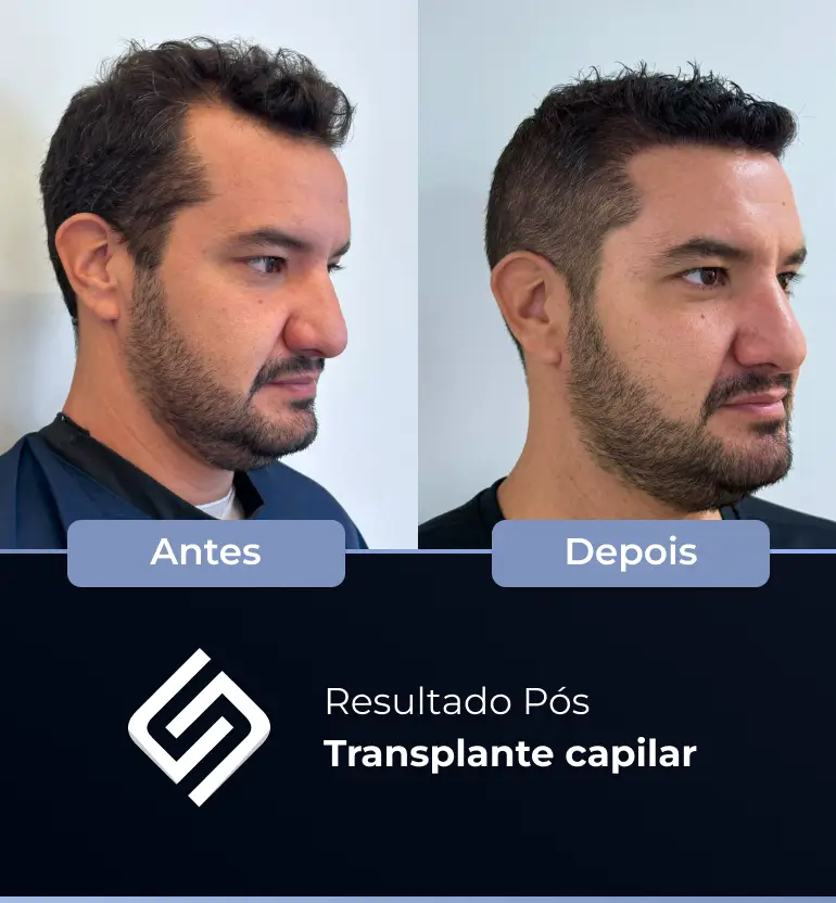 SN - antes e depois tc 20