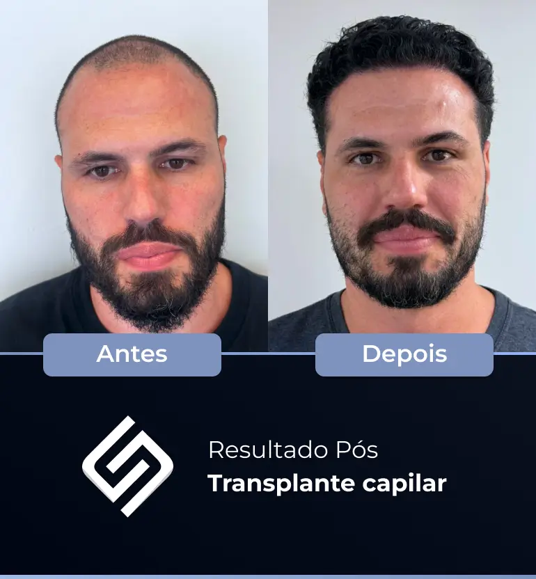 SN - antes e depois tc 21
