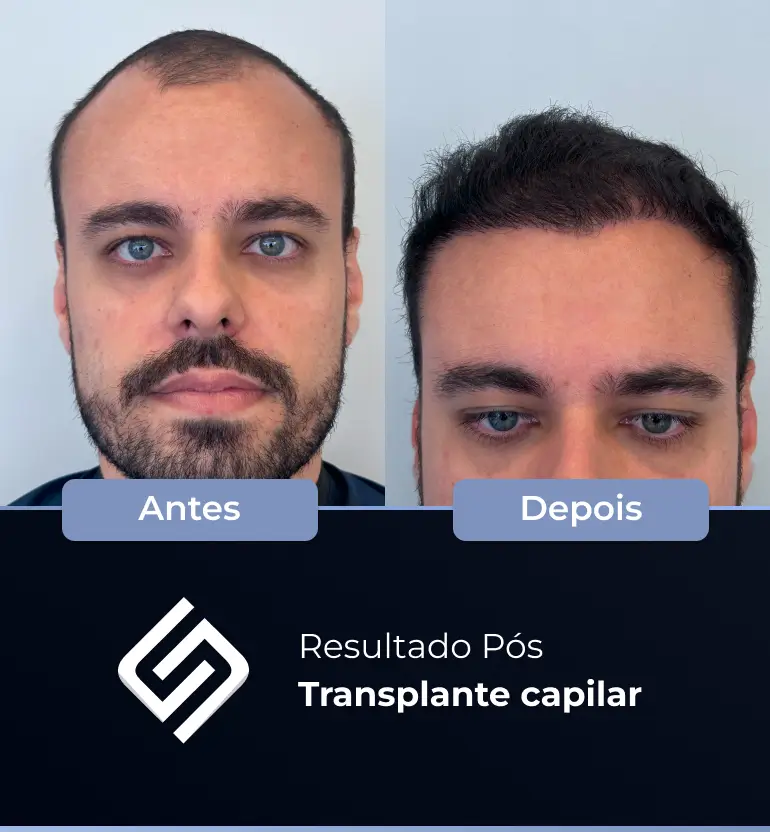 SN - antes e depois tc 3