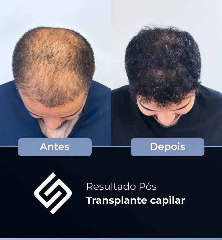 SN - antes e depois tc 5