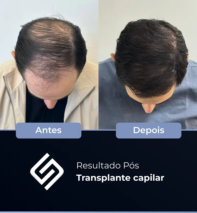 SN - antes e depois tc 8