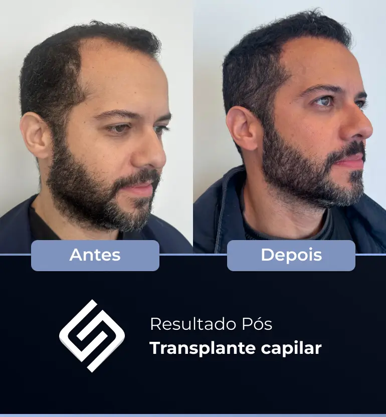 SN - antes e depois tc 9